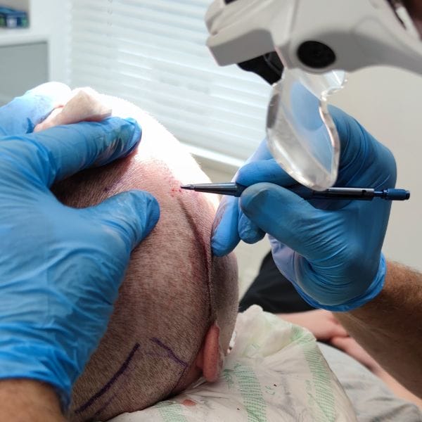 Hair transplant being performed by a doctor in Wales, United kingdom