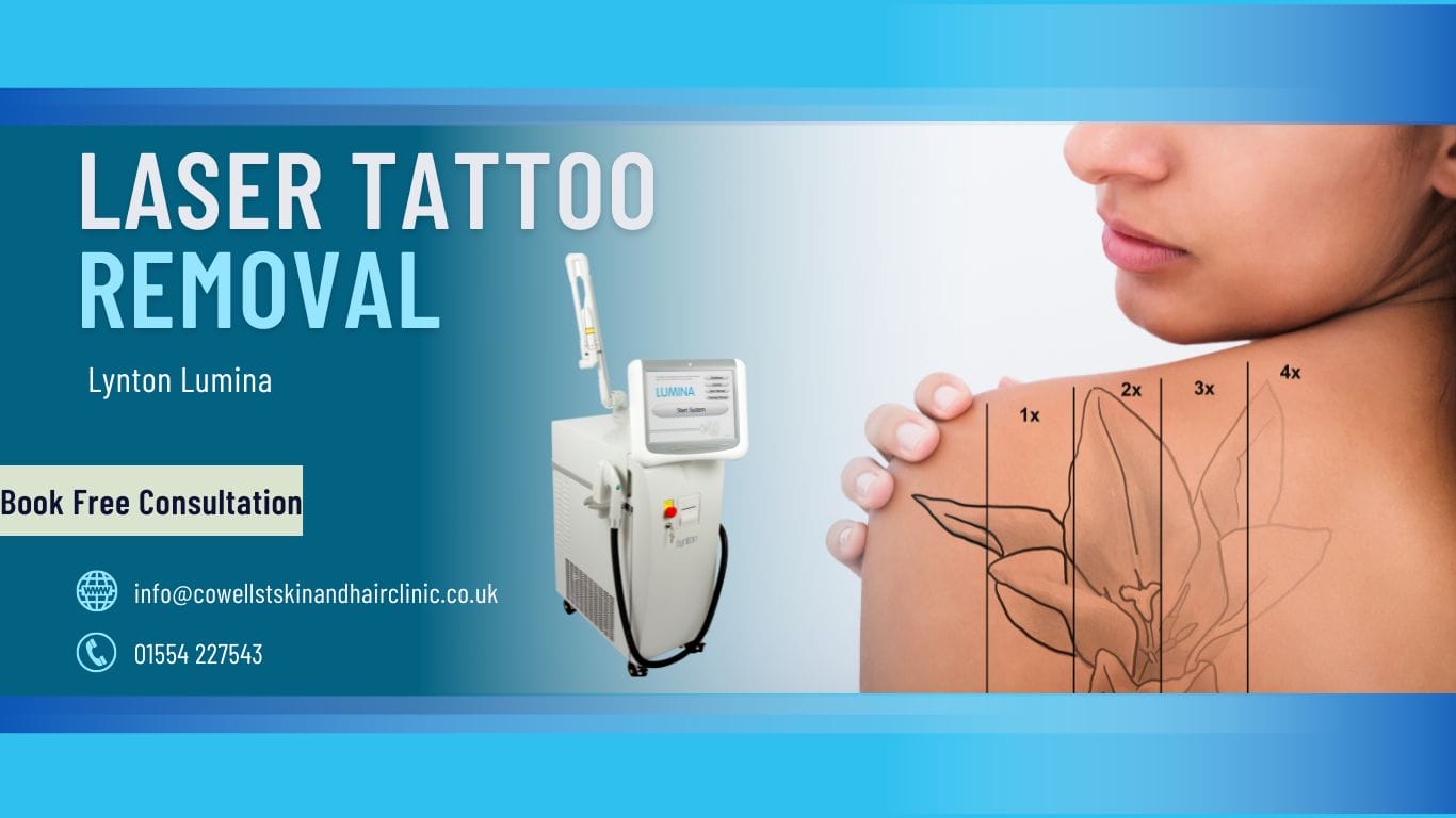 Laser Tattoo Removal Brynmill Swansea - Cowell St Skin & Hair Clinic